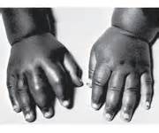 Doleur dans les mains